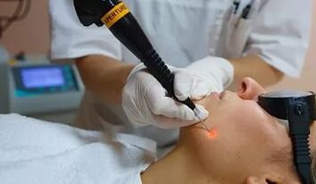 Una procedura efficace per rimuovere i papillomi sul viso utilizzando un laser