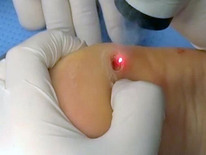 Trattamento laser delle verruche