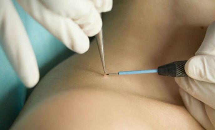 Utilizzo della terapia con onde radio