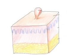 come sbarazzarsi dei papillomi sul corpo