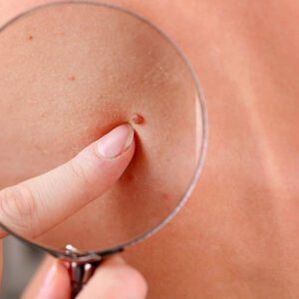 È possibile rimuovere i papillomi