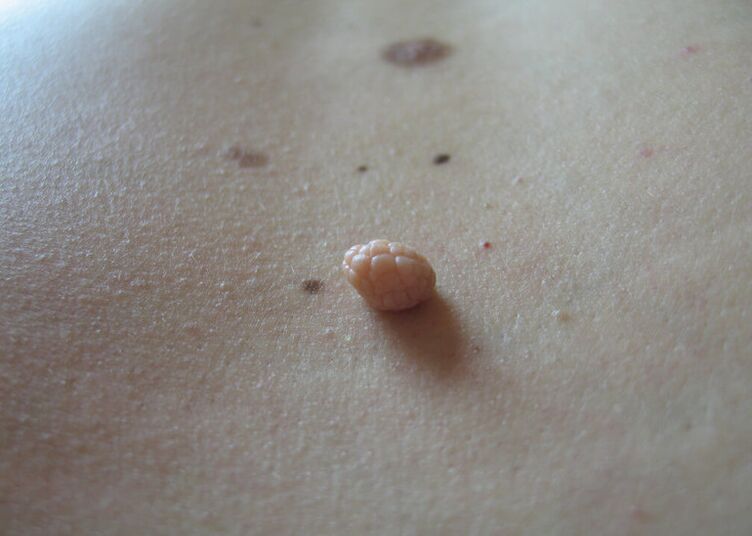 Papillomi sul corpo umano