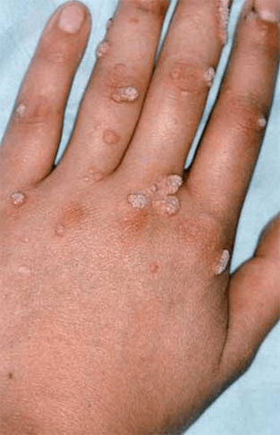 Papillomi sulla mano