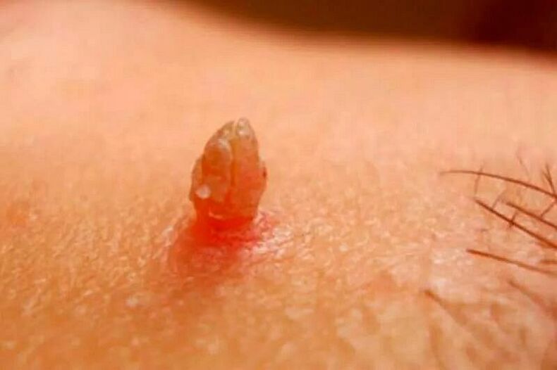 Verruche genitali sul corpo