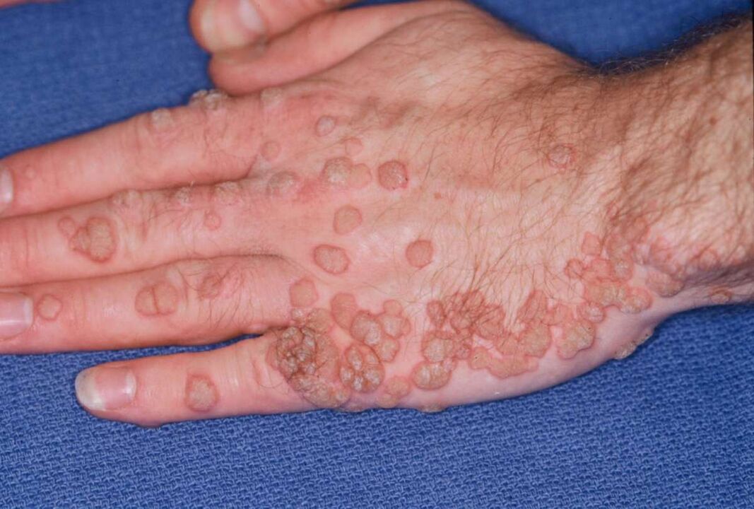 molti papillomi sulle mani