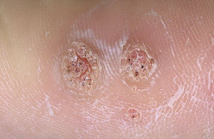 Verruche sul corpo