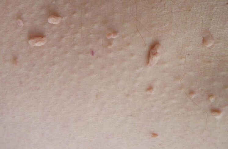 papillomi filamentosi sulla pelle