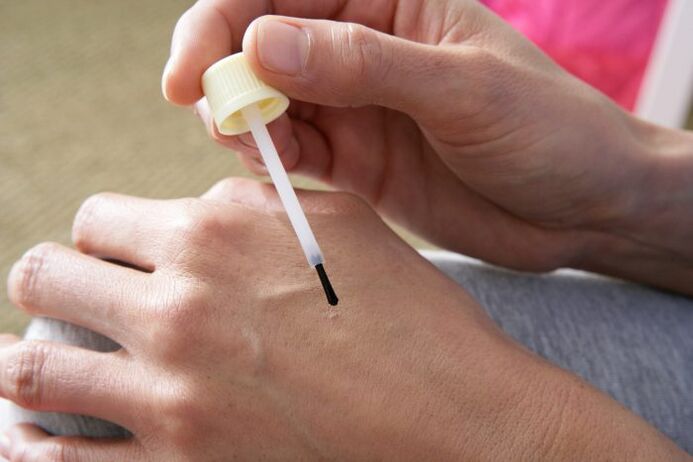 Cauterizzare le verruche con succo di celidonia