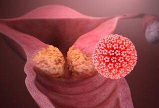 Quali malattie causano l'HPV
